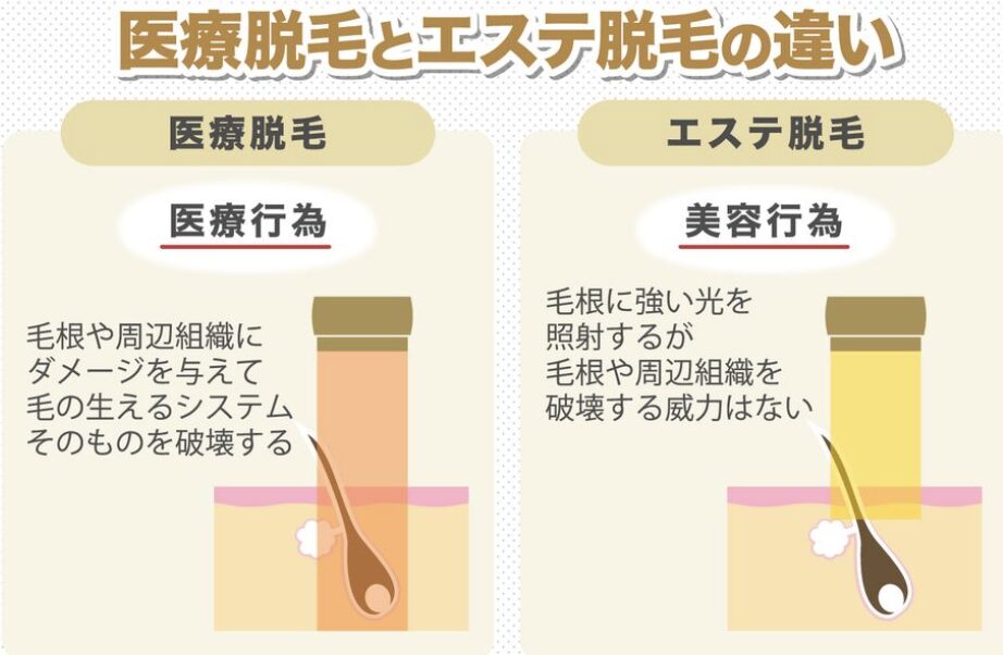 医療脱毛とエステ脱毛の違いを示した画像