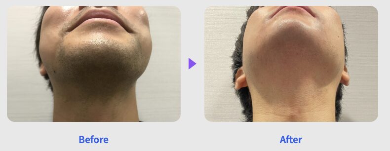 レジーナクリニックオムのデビュープランのビフォーアフター画像